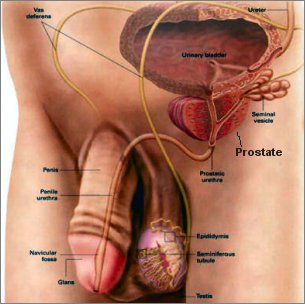 Prostate Cancer Diagram